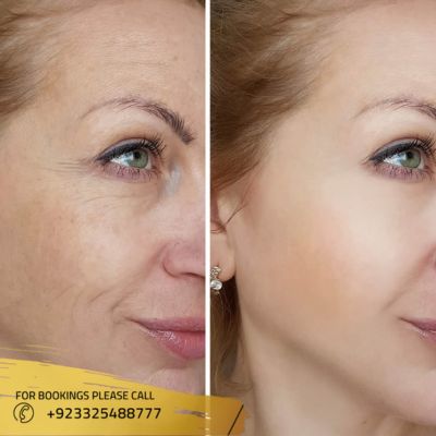 images of skin rejuvenation in Islamabad