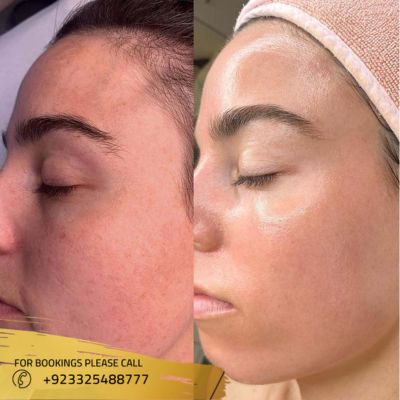 images of skin whitening treatment in Islamabad