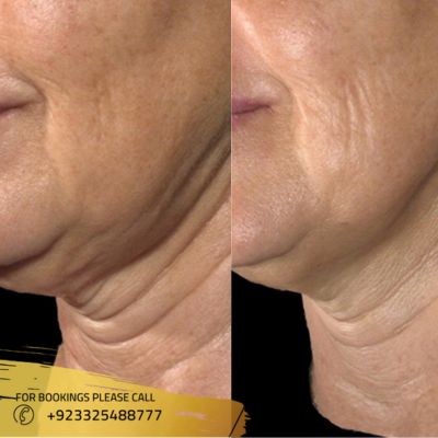 results of skin rejuvenation in Islamabad