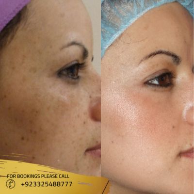 results of skin whitening treatment in Islamabad