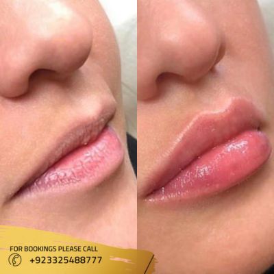 results of smoker lips in Islamabad