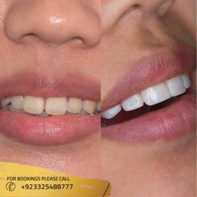 Before after of composite veneers in Islamabad