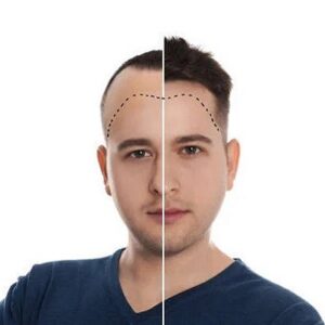 Can Hair Transplants Cause Cancer?
