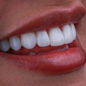 Can Zirconia Crowns Get Cavities?