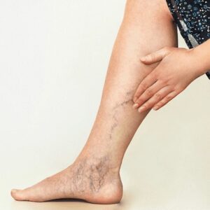 Can spider veins be cured permanently in Islamabad?
