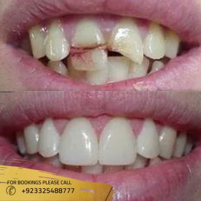 Images of Root canal treatment in Islamabad