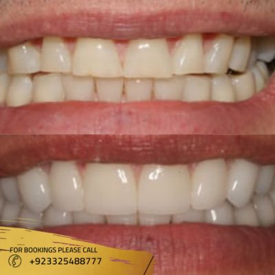 Images of composite veneers in Islamabad