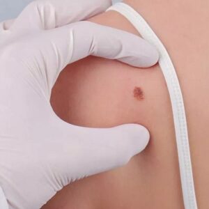 Is a wart poisonous?