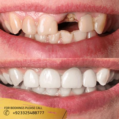 Root canal treatment in Islamabad