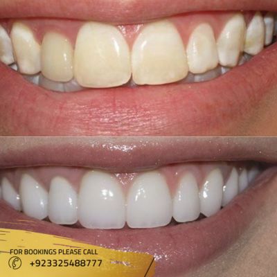 composite veneers treatment in Islamabad