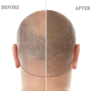How painful is scalp micropigmentation?
