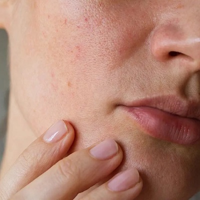 Can large open pores be treated in Islamabad?