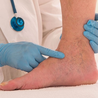 Spider Veins Vs. Varicose Veins Treatment in Islamabad?