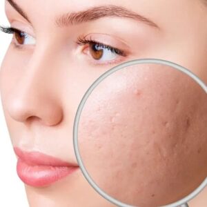 Acne Scar Treatment for Teenagers in Islamabad
