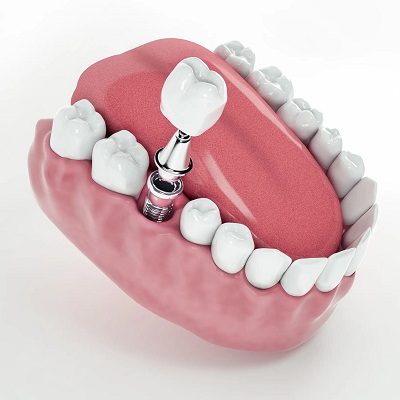 Can Dental Implants Be Covered in A Day?