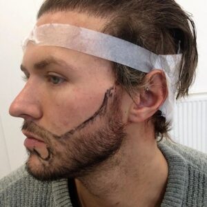 Can We Shave After A Beard Transplant in Islamabad?