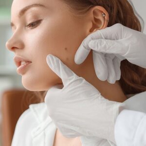Can moles grow back after a laser?