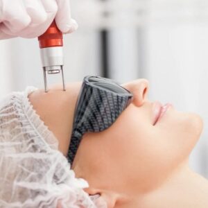 How Many Treatments Are Needed for Pico Laser Treatment?