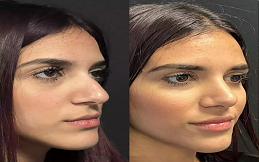 Rhinoplasty cost in Islamabad