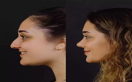 Rhinoplasty surgery before after results
