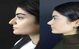 Rhinoplasty surgery before after