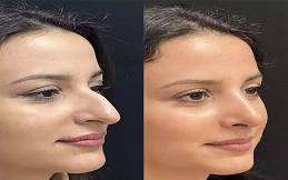Rhinoplasty surgery cost in Islamabad