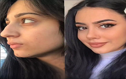 Rhinoplasty surgery in Islamabad