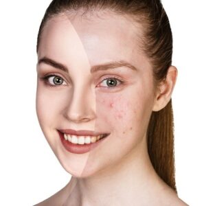 Acne Scar Treatment for Brown Skin in Islamabad