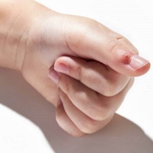 Does removing a wart leave a hole?