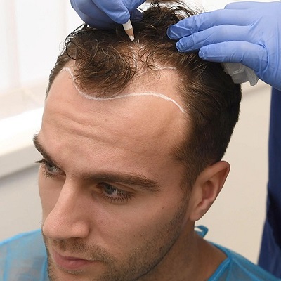 Hair Transplant in Islamabad To Reduce Forehead Size