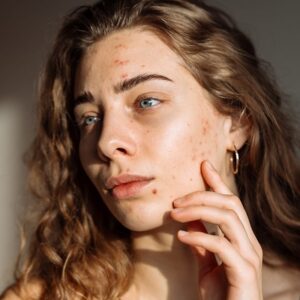 How can I clear my acne scars?