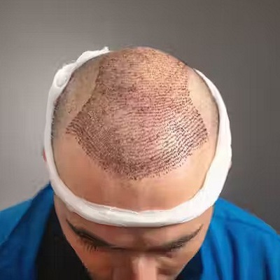 Is It Painful to Get A Hair Transplant in Islamabad?