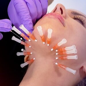 Thread Lift for Double Chin in Islamabad