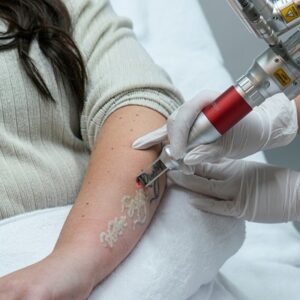 Can you 100% remove a tattoo?