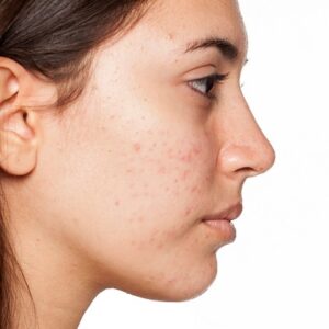 Exploring the Benefits of Acne Scars Treatment