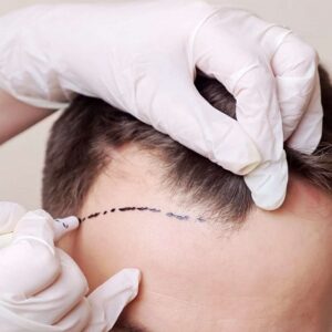 Which cap is best after a hair transplant?
