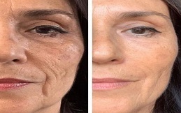 Anti Aging – Anti Wrinkle Treatment before after results