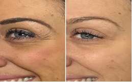 Anti Aging – Anti Wrinkle Treatment before after