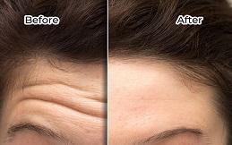 Anti Aging – Anti Wrinkle Treatment cost in Islamabad
