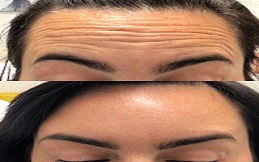 Anti Aging – Anti Wrinkle Treatment in Islamabad