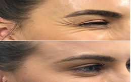 Anti Aging – Anti Wrinkle Treatment