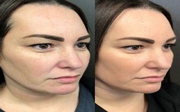 Aquagold Fine Touch Treatment before after results