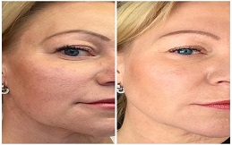 Aquagold Fine Touch Treatment before after