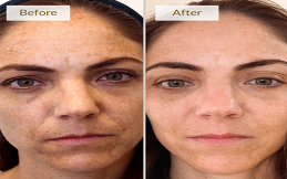 Aquagold Fine Touch Treatment in Islamabad