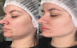 Aqualyx injection before after