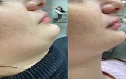 Aqualyx injection before results