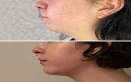 Aqualyx injection in Islamabad