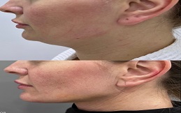 Aqualyx injection surgery in Islamabad