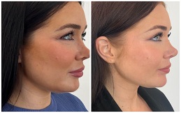 Aqualyx injection treatment in Islamabad