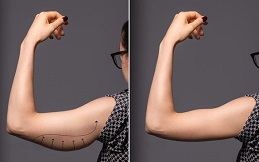 Arm Lift Brachioplasty before after